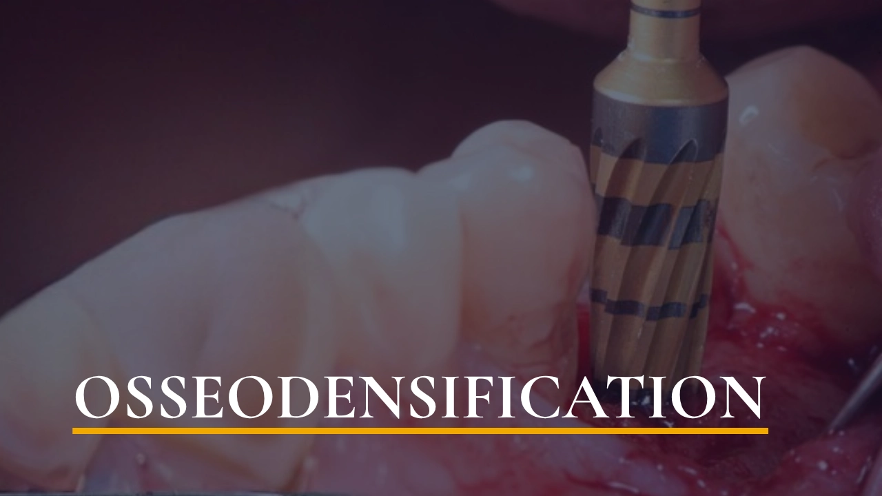 Osseodensification — An Innovative Drilling Technique